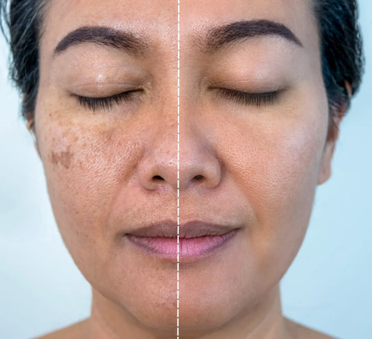 Dark Spots and Dull Skin