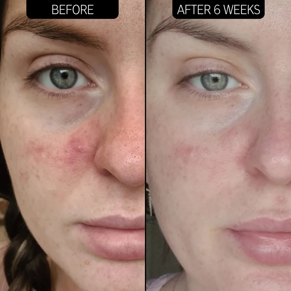 the ordinary azelaic acid application difference-khayest