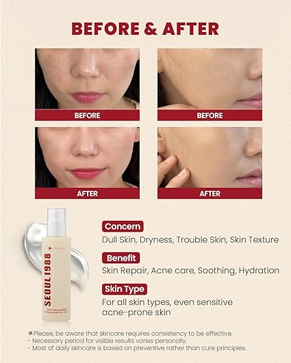 Before and after images showing the effectiveness of KSECRET SEOUL 1988 Snail Mucin Essence in improving skin texture and reducing acne.

