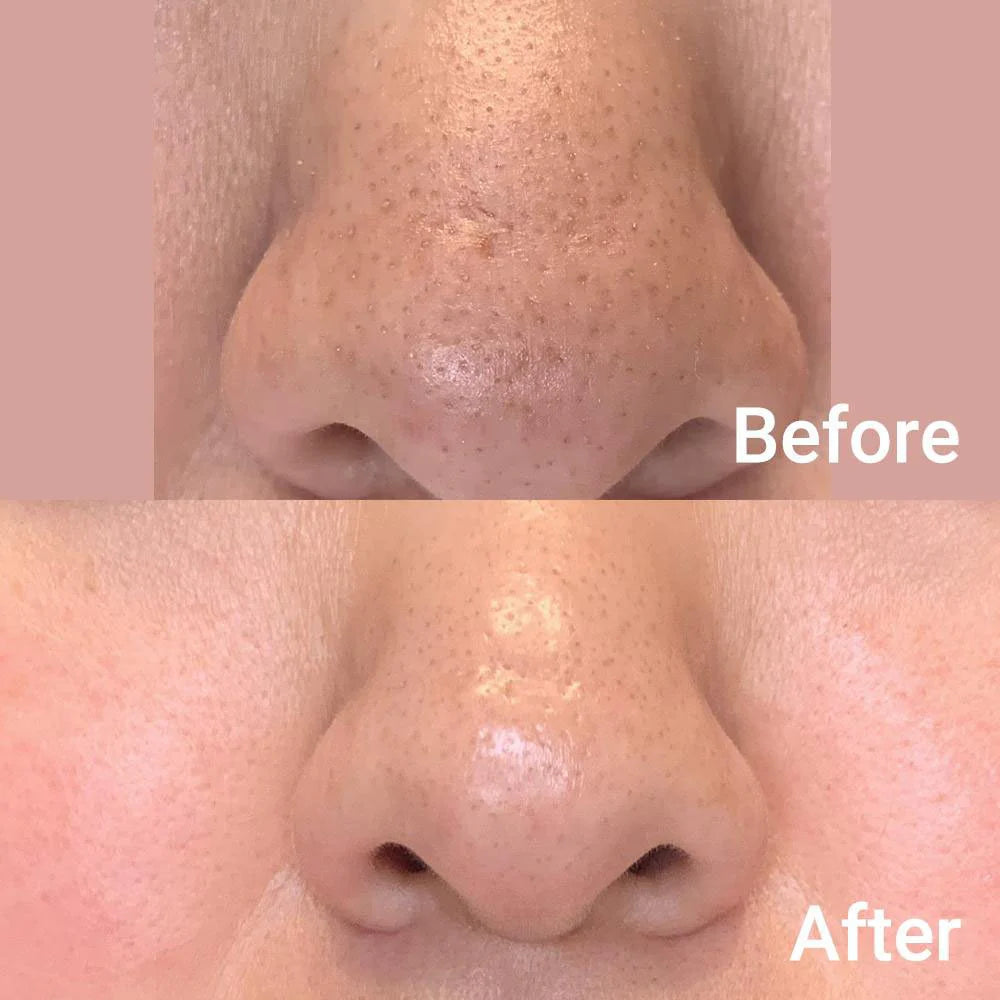 Medicube Zero Pore Pad 2.0 155g - Khayest